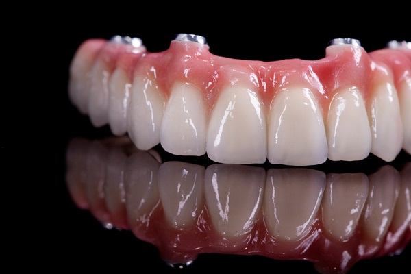 All On  ® Is A Full Arch Dental Restoration