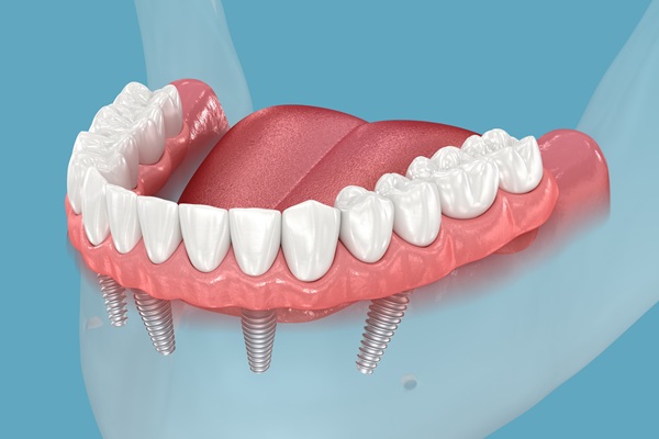Why All On  ® Dentures May Be The Better Choice For You
