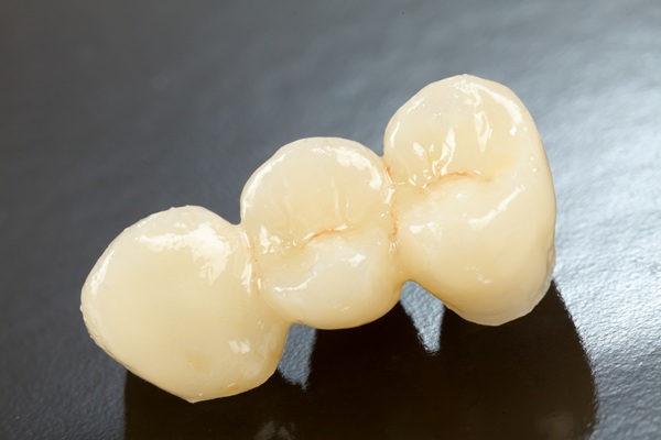 Dental Bridges: A Lasting Solution For Missing Teeth