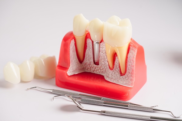 Simple Steps To Place Dental Implants