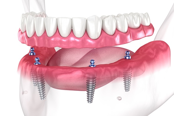 Implant Overdentures: A Secure And Comfortable Alternative To Traditional Dentures